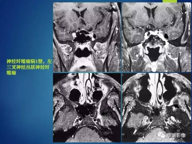 【PPT】12对颅神经影像检查