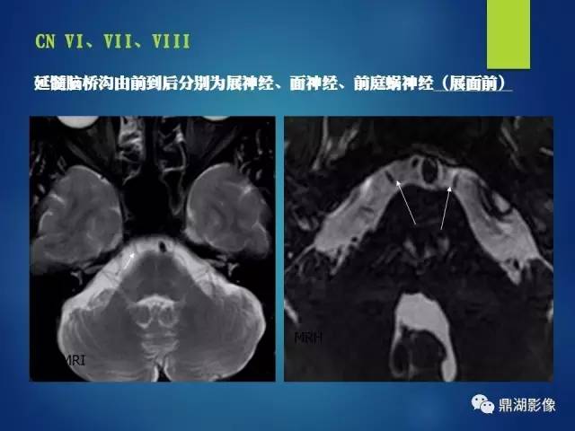 【PPT】12对颅神经影像检查