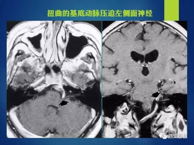 【PPT】12对颅神经影像检查