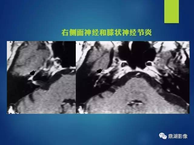 【PPT】12对颅神经影像检查