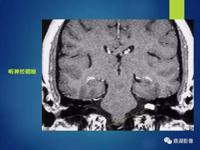【PPT】12对颅神经影像检查