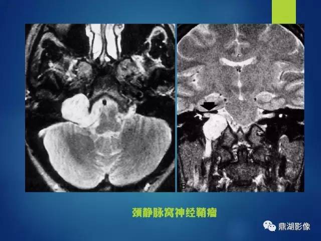 【PPT】12对颅神经影像检查