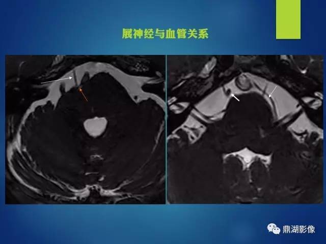 【PPT】12对颅神经影像检查