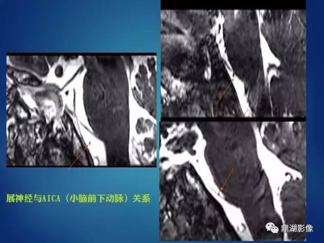 【PPT】12对颅神经影像检查