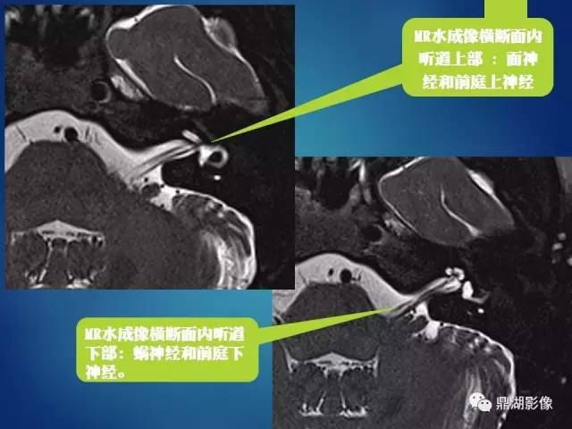 【PPT】12对颅神经影像检查