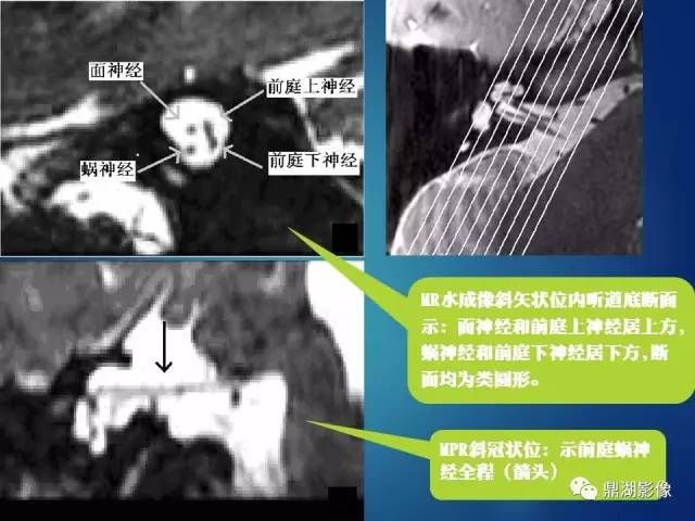 【PPT】12对颅神经影像检查