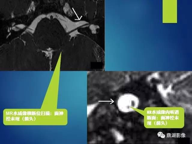 【PPT】12对颅神经影像检查