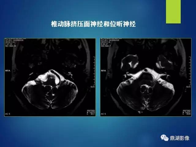 【PPT】12对颅神经影像检查