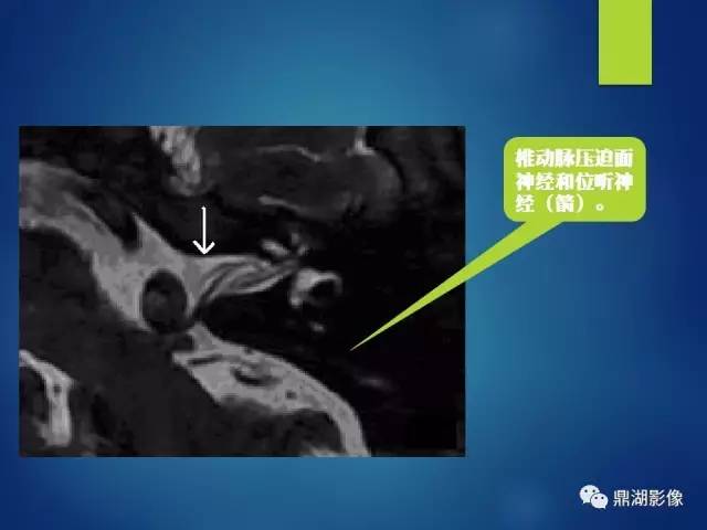 【PPT】12对颅神经影像检查