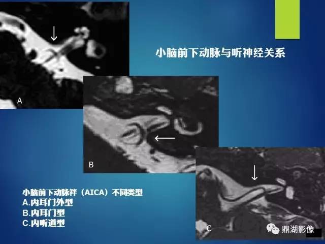 【PPT】12对颅神经影像检查