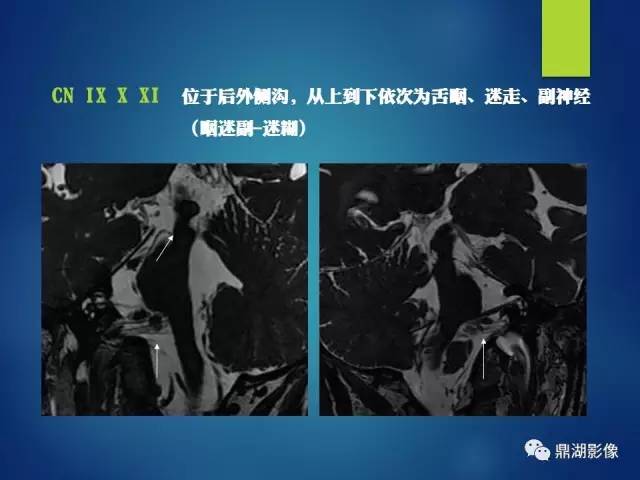 【PPT】12对颅神经影像检查