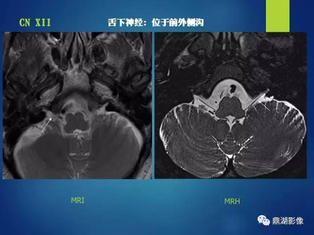 【PPT】12对颅神经影像检查
