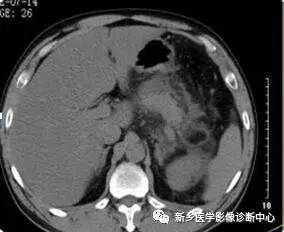 值夜班必须掌握的21种腹部疼痛原因 值夜班必须掌握的21种腹部疼痛原因