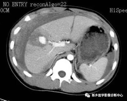 值夜班必须掌握的21种腹部疼痛原因 值夜班必须掌握的21种腹部疼痛原因