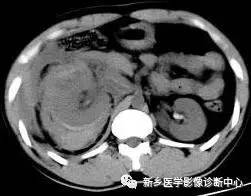 值夜班必须掌握的21种腹部疼痛原因 值夜班必须掌握的21种腹部疼痛原因