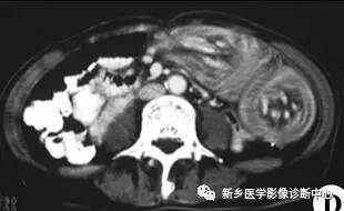 值夜班必须掌握的21种腹部疼痛原因 值夜班必须掌握的21种腹部疼痛原因