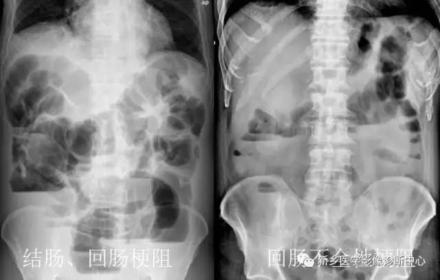 值夜班必须掌握的21种腹部疼痛原因 值夜班必须掌握的21种腹部疼痛原因