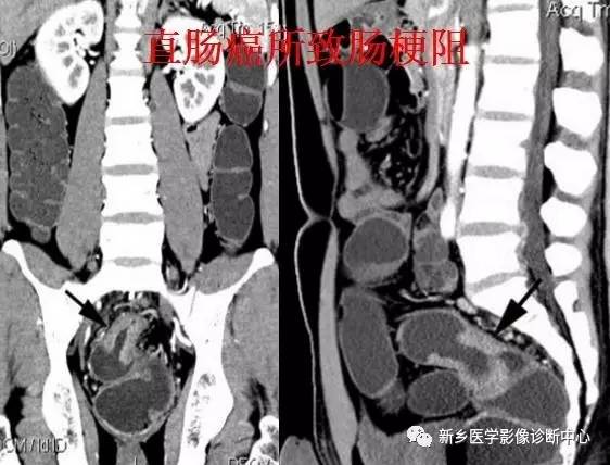 值夜班必须掌握的21种腹部疼痛原因 值夜班必须掌握的21种腹部疼痛原因