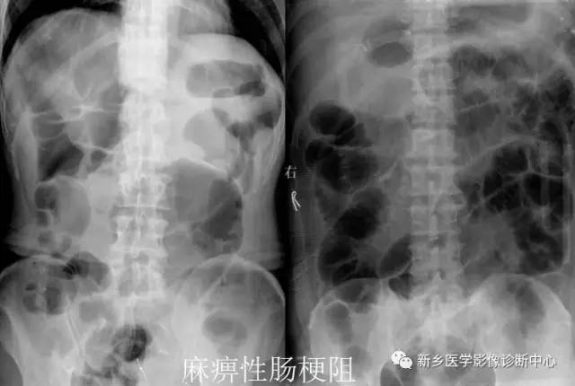 值夜班必须掌握的21种腹部疼痛原因 值夜班必须掌握的21种腹部疼痛原因