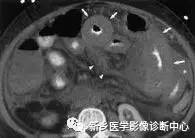 值夜班必须掌握的21种腹部疼痛原因 值夜班必须掌握的21种腹部疼痛原因