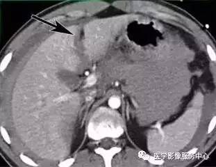 胸腹腔出血与脑出血在CT上的密度为什么差别很大？
