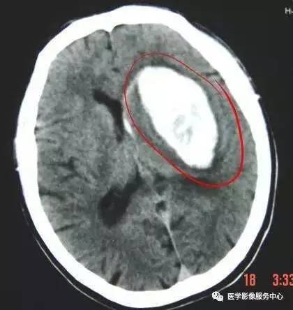 胸腹腔出血与脑出血在CT上的密度为什么差别很大? 胸腹腔出血与脑出血在CT上的密度为什么差别很大?