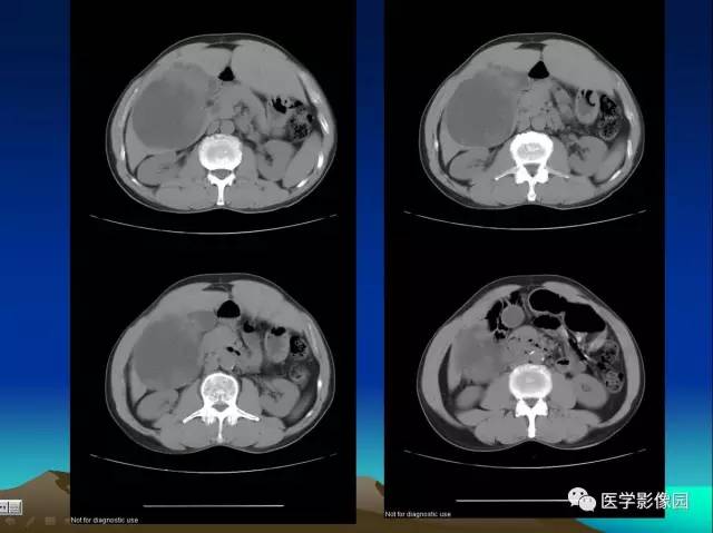 【病例】肝脏囊腺瘤1例CT影像表现 【病例】肝脏囊腺瘤1例CT影像表现