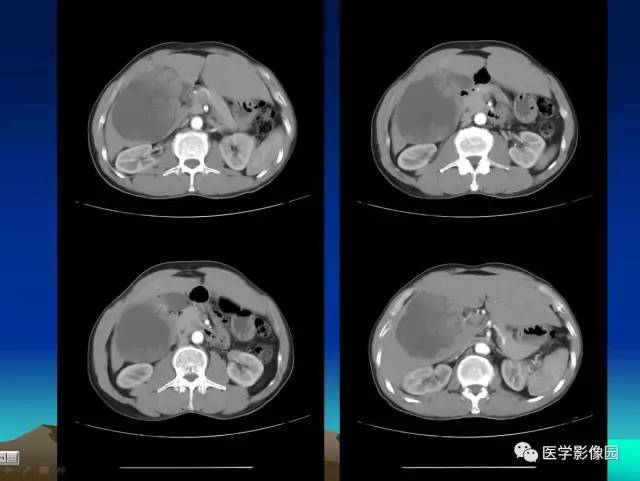 【病例】肝脏囊腺瘤1例CT影像表现 【病例】肝脏囊腺瘤1例CT影像表现