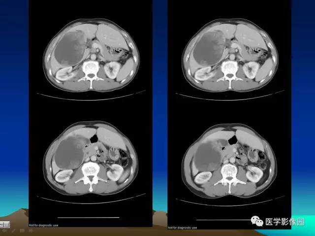 【病例】肝脏囊腺瘤1例CT影像表现 【病例】肝脏囊腺瘤1例CT影像表现