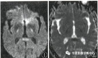 【病例】低血糖脑病HE一例MR影像表现