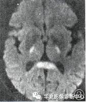 【病例】低血糖脑病HE一例MR影像表现