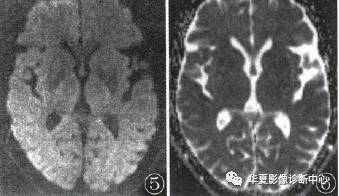 【病例】低血糖脑病HE一例MR影像表现