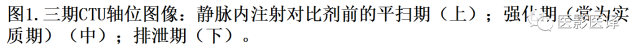 CT尿路造影在输尿管疾病的应用 CT尿路造影在输尿管疾病的应用