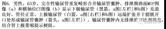 CT尿路造影在输尿管疾病的应用 CT尿路造影在输尿管疾病的应用