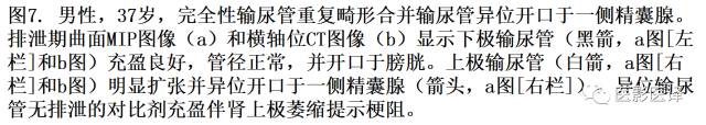 CT尿路造影在输尿管疾病的应用 CT尿路造影在输尿管疾病的应用