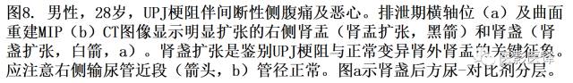 CT尿路造影在输尿管疾病的应用 CT尿路造影在输尿管疾病的应用