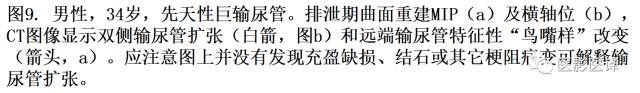 CT尿路造影在输尿管疾病的应用 CT尿路造影在输尿管疾病的应用