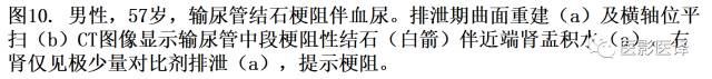 CT尿路造影在输尿管疾病的应用 CT尿路造影在输尿管疾病的应用