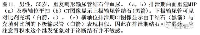 CT尿路造影在输尿管疾病的应用 CT尿路造影在输尿管疾病的应用
