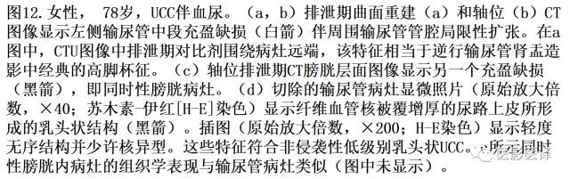 CT尿路造影在输尿管疾病的应用 CT尿路造影在输尿管疾病的应用