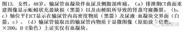 CT尿路造影在输尿管疾病的应用 CT尿路造影在输尿管疾病的应用