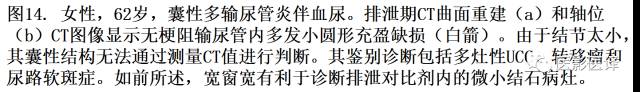 CT尿路造影在输尿管疾病的应用 CT尿路造影在输尿管疾病的应用