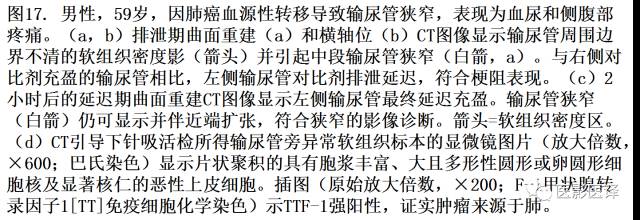 CT尿路造影在输尿管疾病的应用 CT尿路造影在输尿管疾病的应用