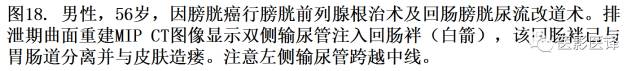 CT尿路造影在输尿管疾病的应用 CT尿路造影在输尿管疾病的应用