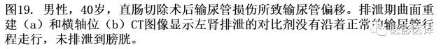 CT尿路造影在输尿管疾病的应用 CT尿路造影在输尿管疾病的应用