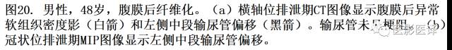 CT尿路造影在输尿管疾病的应用 CT尿路造影在输尿管疾病的应用