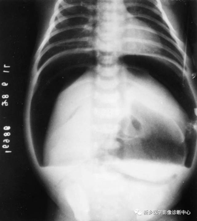 值夜班不能忽视的10种儿童腹痛原因 值夜班不能忽视的10种儿童腹痛原因