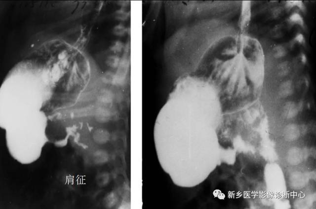 值夜班不能忽视的10种儿童腹痛原因 值夜班不能忽视的10种儿童腹痛原因