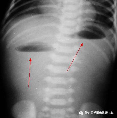 值夜班不能忽视的10种儿童腹痛原因 值夜班不能忽视的10种儿童腹痛原因