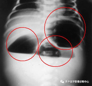 值夜班不能忽视的10种儿童腹痛原因